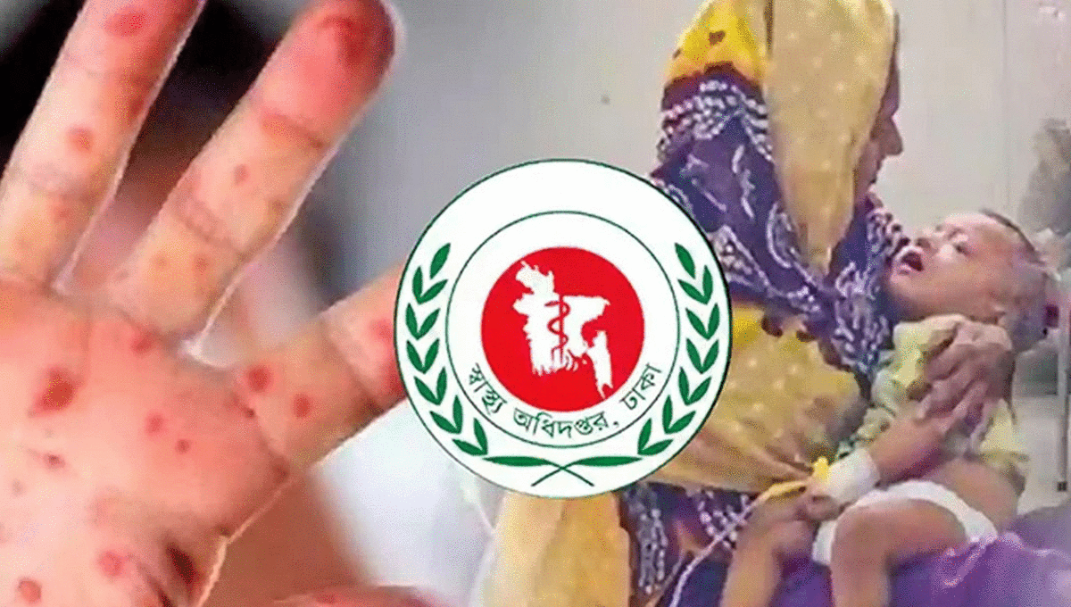 ২৪ ঘণ্টায় হাম ও হামের উপসর্গে আরও ১১ জনের মৃত্যু
