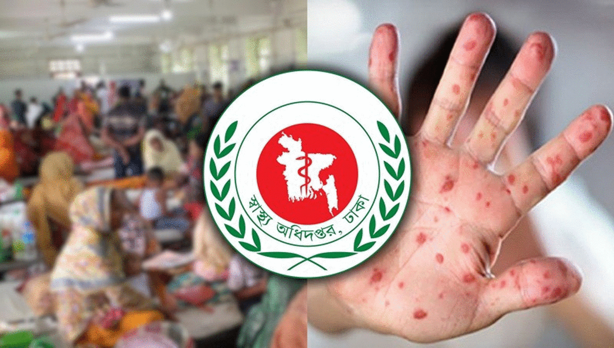 ২৪ ঘণ্টায় হামের উপসর্গে আরও ৫ মৃত্যু