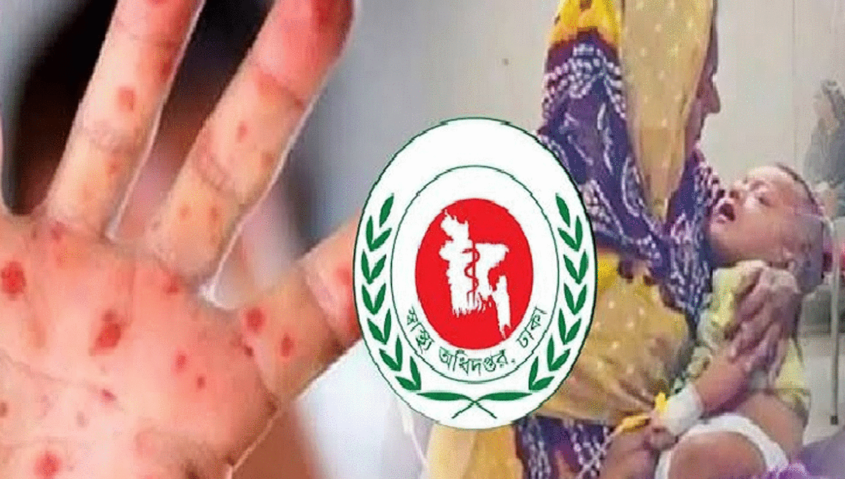 হামে এক দিনে ৪ শিশুর মৃত্যু, নতুন আক্রান্ত ১,২৪২